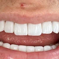 کامپوزیت دندان|خدمات آرایشگری و زیبایی|پرند, فاز ۶|دیوار