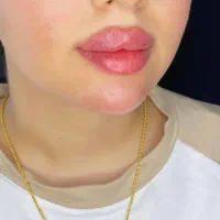 مدل زیبایی بوتاکس، ژل و فیلر