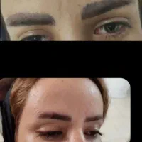ریموو(پاک کردن)تتو ابرو چشم لب وبدن ۵۰درصد تخفیف