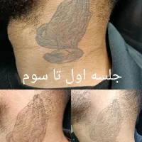 لیزر پاک کردن تتو کیوسویچ پلاس