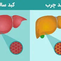درمان کبد چرب کاملا گیاهی