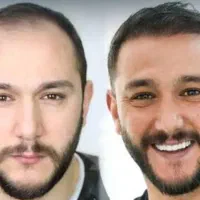 کاشت مو و ابرو تانیا