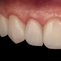 طراحی لبخند به سبک لوکس (شرایط ویژه اقساطی(