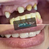 دندانپزشکی،روکش بریج،لمینت،دندان مصنوعی