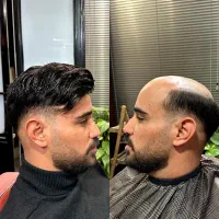 پروتز مو قم