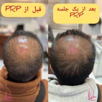 پی ار پی مو،صورت،اگزوزوم،مزوتراپی،هیرفیلر PRP|خدمات آرایشگری و زیبایی|تهران, هفت حوض|دیوار