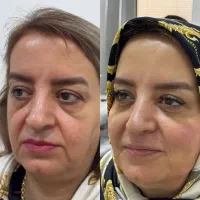جشنواره تخفیف ژل ،بوتاکس و جوانساز و لیزر موزائد
