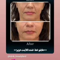 هایفو تراپی جوانسازی فقط سالی یکبار نتیجه انی