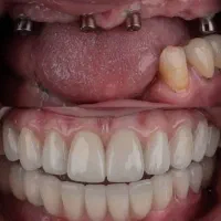 دندان ثابت میخوای...ایمپلنت ۱۲ ماهه بزن