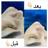 پاکسازی پوست به صورت حرفه ای فقط ۴۰۰ت|خدمات آرایشگری و زیبایی|قائمشهر, |دیوار