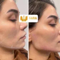 تزریق ژل و بوتاکس|خدمات آرایشگری و زیبایی|اهواز, نادری|دیوار