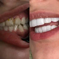دندون پزشکی اقساطی کامپوزیت اقساطی 12 ماهه|خدمات آرایشگری و زیبایی|تهران, خانی آباد نو شمالی|دیوار