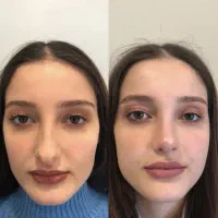 جراحی زیبایی بینی