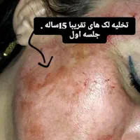 اولین درمانگرلک با متدپکینگ آپ وحذف تک جلسه کک مک|خدمات آرایشگری و زیبایی|بوشهر, |دیوار