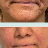 کلاژن مزوتراپی مزونیدلینگ|خدمات آرایشگری و زیبایی|مشهد, کوثر|دیوار