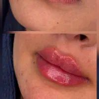 کلینیک پوست مو زیبایی گلد(فیلر ژل مزو بوتاکس)