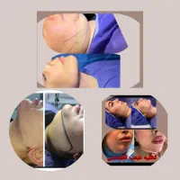 ساکش غبغب تزریق .باسن.شکم|خدمات آرایشگری و زیبایی|کرمانشاه, |دیوار