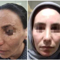 لیزرco2تک جلسه ای،تزریق چربی، دیگر خدمات زیبایی|خدمات آرایشگری و زیبایی|دهدشت, |دیوار