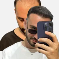 کاشت مو تبریزقیمت مناسب اقساطی فول تراکم