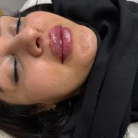 تزریق ژللب ،گونه،زاویه فک و چانه و بوتاکس،مادلینگ|خدمات آرایشگری و زیبایی|اصفهان, رکن الدوله شرقی|دیوار