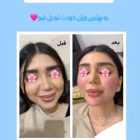 ژل/بوتاکس/مزو ژل/وآموزش|خدمات آرایشگری و زیبایی|خرمشهر, |دیوار