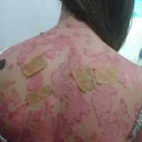 درمان بیماریها به روش tts