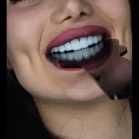 کامپوزیت دندان با بهترین مواد