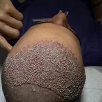 کاشت مو و ابرو تخصصی با تیم کاشت شیرازی