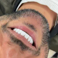 کامپوزیت و لمینت دندان با ضمانت و اقساط بدون سود|خدمات آرایشگری و زیبایی|تهران, امیرآباد|دیوار