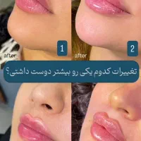 تزریق ژل و بوتاکس تضمینی (کلنیک ایرانا)|خدمات آرایشگری و زیبایی|یاسوج, |دیوار