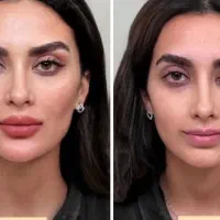 آفر تزرریقات ژل و بوتاکس فشیال