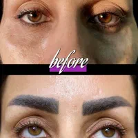 تزریقات فیلر و بوتاکس توسط پزشک