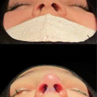 جشنواره عمل بینی به سبک جراحان ترکیه|خدمات آرایشگری و زیبایی|لامرد, |دیوار