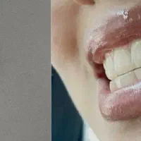 درمان کیست دندون میخواستم