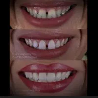 ارائه خدمات کامپوزیت ولمینیت دندان (ونیرکامپوزیت )|خدمات آرایشگری و زیبایی|کرج, مهرویلا جنوبی|دیوار