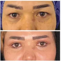دروغ ممنوع/ بلفاروپلاستی جراحی پلک|خدمات آرایشگری و زیبایی|تهران, پونک|دیوار