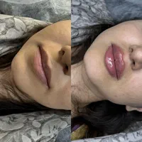 جشنواره فیلر صورت و لب در کلینیک ویرا