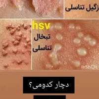 بهبود زگیل تناسلی و مشکلات جنسی