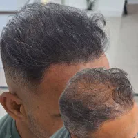 میکرواسکالپ / مکمل کاشت مو