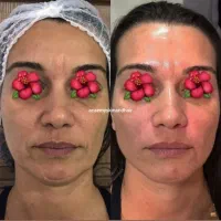 بمب تخفیف ژل ،بوتاکس،نخ وغیره فقط دوهفته لارم|خدمات آرایشگری و زیبایی|لار, |دیوار