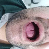 دندانسازی (دندان مصنوعی)پروتز متحرک