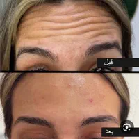 خدمات زیبایی بوتاکس ، ژل ،مزوتراپی، ریمو تتو هایفو|خدمات آرایشگری و زیبایی|فولادشهر, B2|دیوار