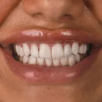 دندانپزشکی بیمه تکمیلی