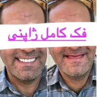 دندانسازی / دندان مصنوعی/ جوان پسند لمینتی/اقساط|خدمات آرایشگری و زیبایی|مشهد, عبادی|دیوار