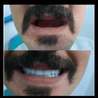 ساخت دندان مصنوعی و روکش دندان بدون واسطه|خدمات آرایشگری و زیبایی|شیراز, پودنک|دیوار