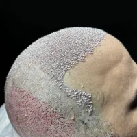 جشنواره کاشت تخصصی مو فول تراکم ۷ ملیون یک هفته|خدمات آرایشگری و زیبایی|تهران, ونک|دیوار