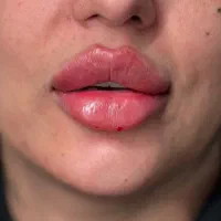 خدمات فیلروبوتاکس|خدمات آرایشگری و زیبایی|سنندج, |دیوار