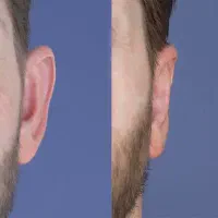 جشنواره جراحی /اتوپلاستی/بلفارو/غبغب|خدمات آرایشگری و زیبایی|تهران, قلهک|دیوار