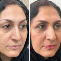 جشنواره تخفیفات بلفاروپلاستی