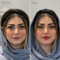 کلینیک زیبایی ژل لب روسی فیلر زاویه مزوبوتاکس لیزر|خدمات آرایشگری و زیبایی|شهریار, شهریار|دیوار